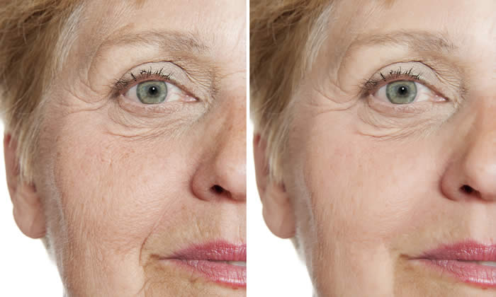 crema antirughe migliore: foto prima e dopo